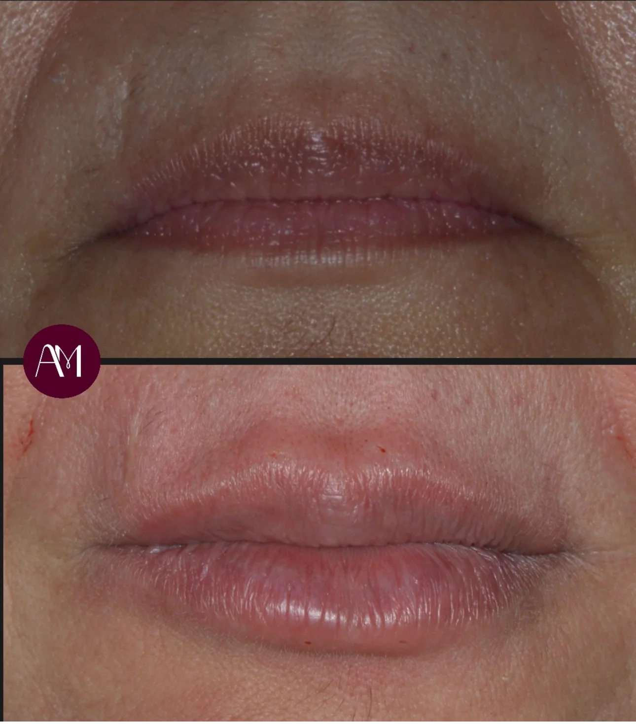 Preenchimento labial sem medo: mitos, verdades e a importância do equilíbrio na estética facial